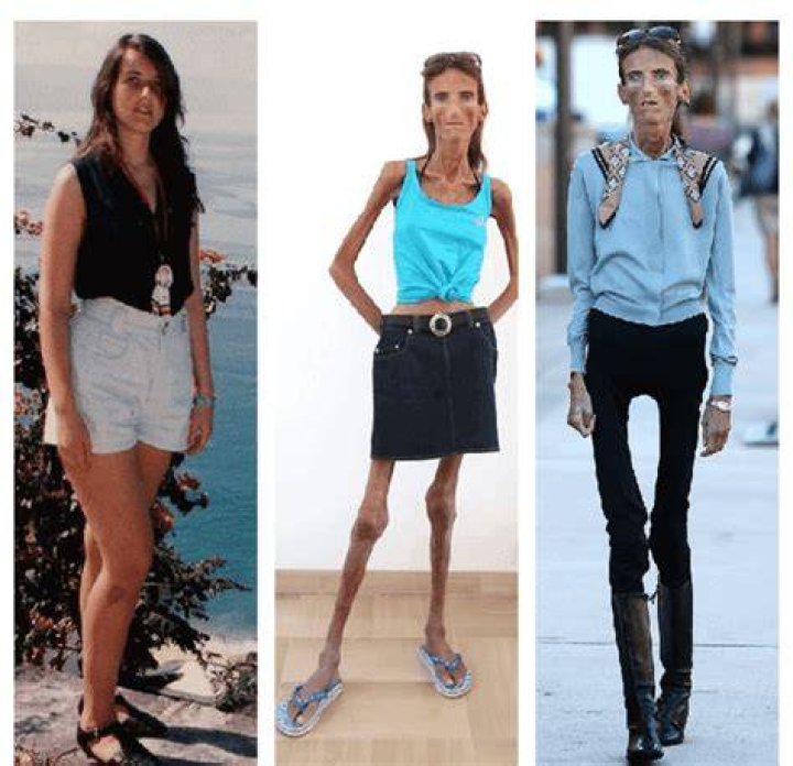 Who is the Skinniest Person in the World? Discover Their Incredible Journey